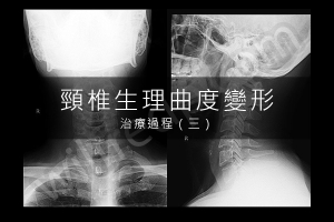 頸椎生理曲度變形 / Military Neck 治療記錄 :: WilfredP