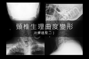 頸椎生理曲度變形 / Military Neck 治療記錄 :: WilfredP